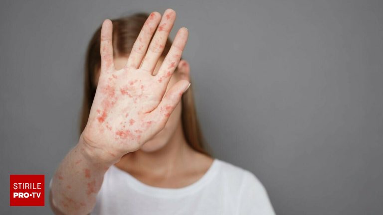 Reapariia rujeolei n Spania migrani nevaccinai