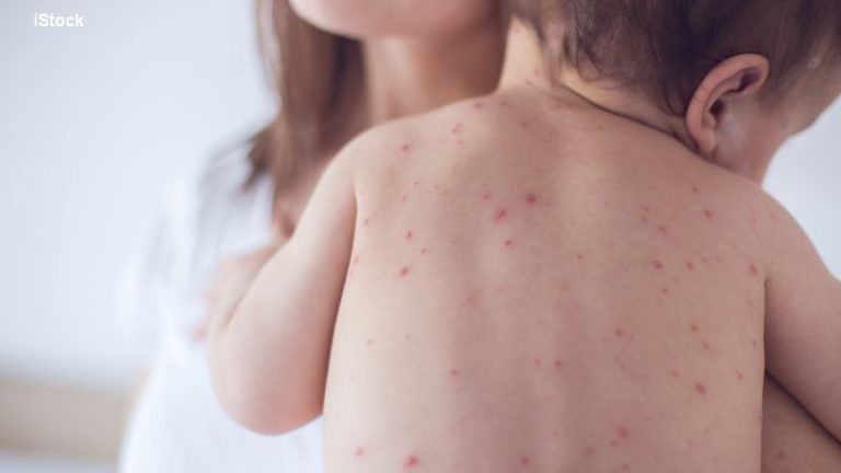 epidemie de rujeola in nordul londrei 60 de copii au fost infectati